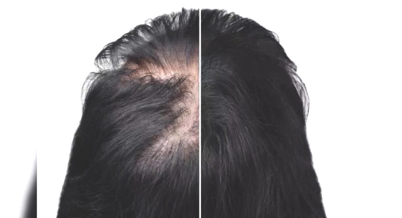 Discover Effective Home Remedies to Combat Alopecia and Hair Loss!